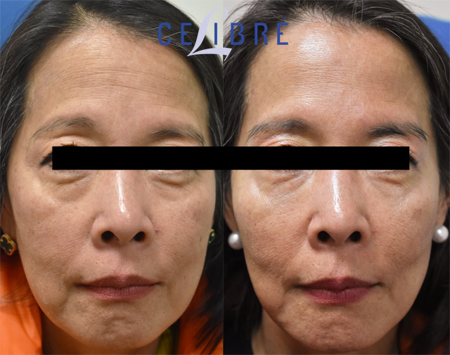 Before and after Sculptra treatment at Celibre Medical Torrance showing improved facial volume, smoother skin texture, and natural rejuvenation results one year later.