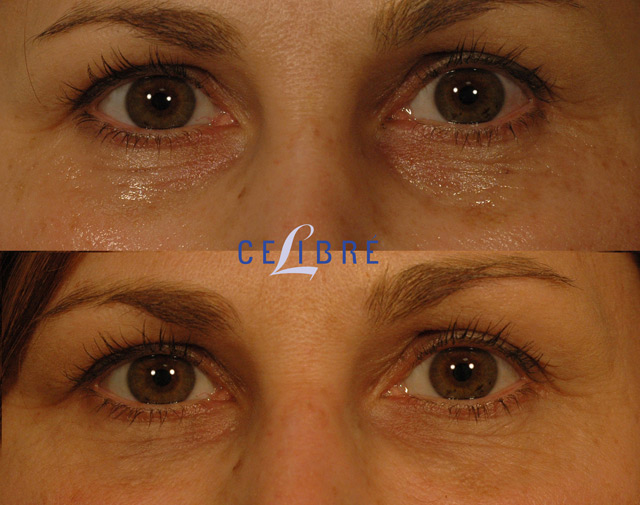 Non-Surgical Treatment for Thin Eyelid Skin, Hollowing, and Dark Under Eye  Circles 