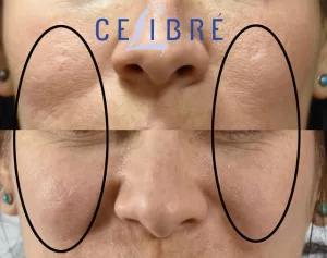 fractional laser resurfacing for acne scars before and after photos