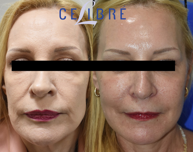 Sculptra Los Angeles before and after photos showing natural-looking facial volume restoration and rejuvenation results.