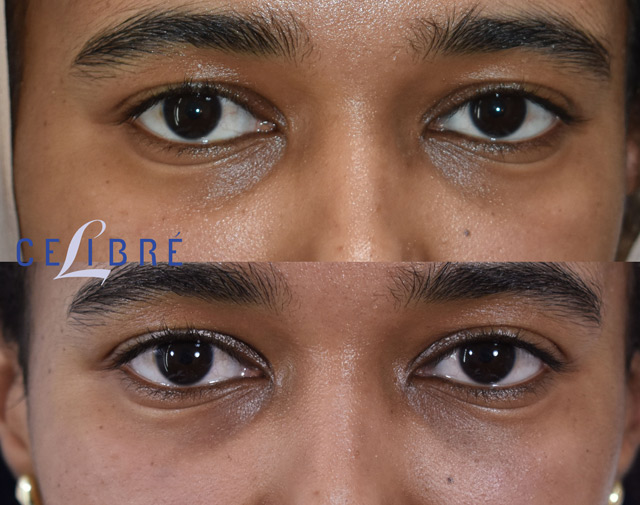 Under Eye Filler: The Best Treatments for Under Eye Bags, Dark