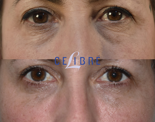 45 dark circles before after filler injections