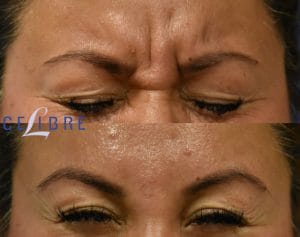 Who can give Botox injections