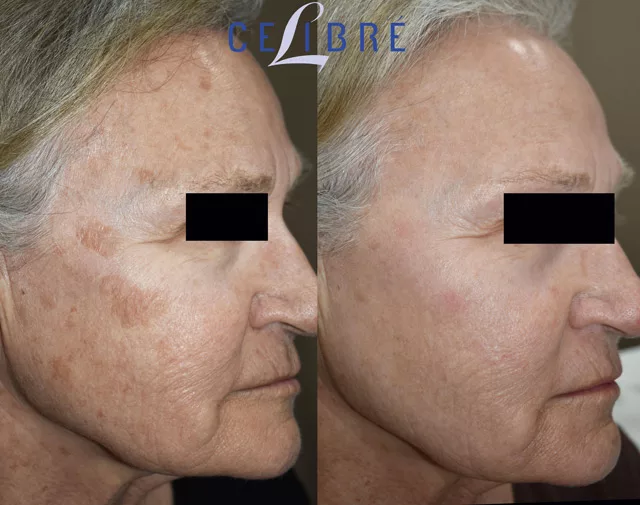 Age Spot Removal Before and After Pictures