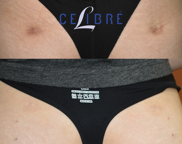 Liposuction scar revision with laser treatments showing smoother skin texture, reduced scarring, and visible before and after improvement.