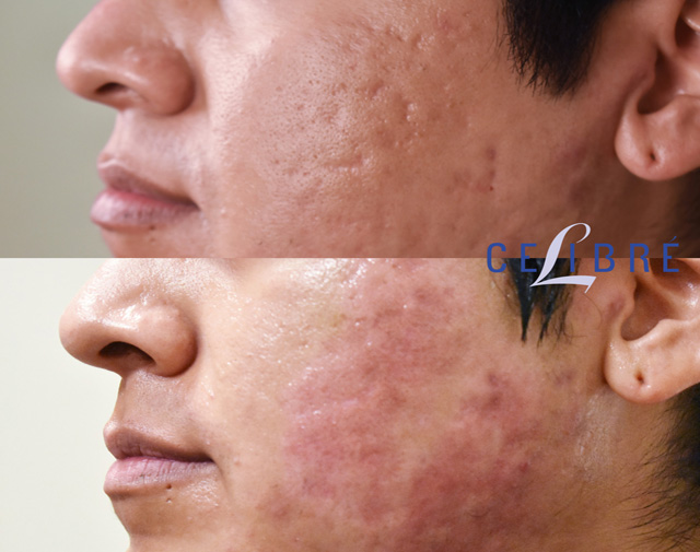 Acne Scar Removal Before Pictures of Actual Patients