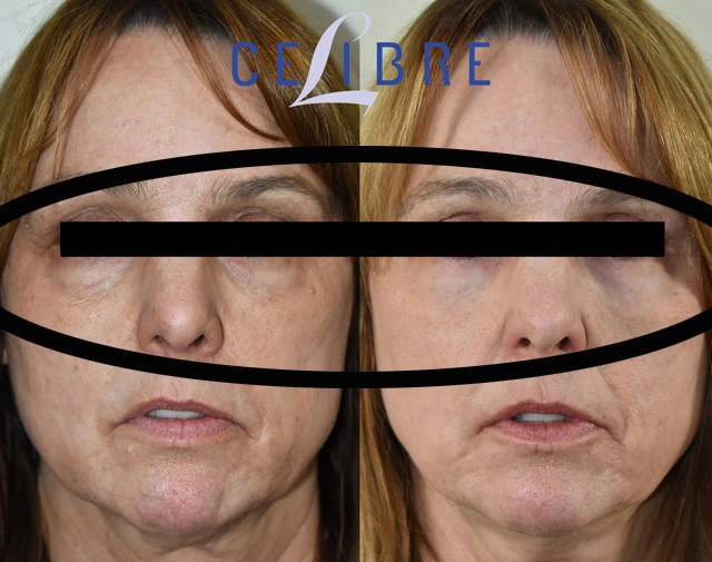 Get rid of eye wrinkles before after shows smoother skin, softened lines, refreshed appearance, brighter eyes, renewed confidence naturally.