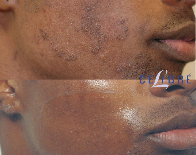 Laser Hair Removal Before and After Pictures of Actual Patients