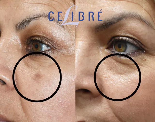 🥇 Getting Rid of Under Eye Bags without Surgery | Beverly Hills, CA