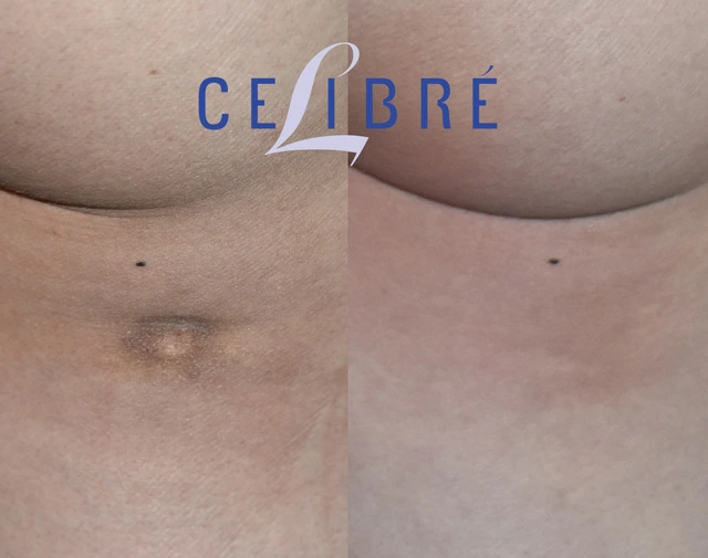 Laser liposuction scar removal before and after photos showing reduced scar visibility, smoother skin, and noticeable improvement results.