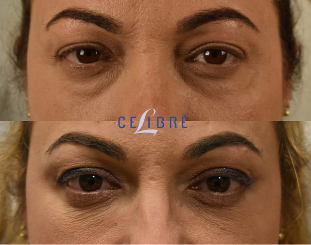 belotero before and after under eyes