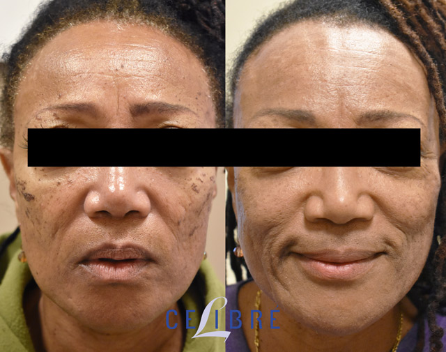 Laser skin deals resurfacing