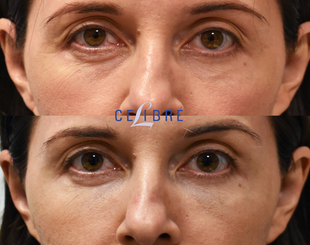 Solution Puffy Under Eyes After Filler Injection  Dr Brett Kotlus  Cosmetic Oculoplastic Surgeon NYC