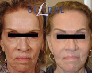 Sculptra collagen before after