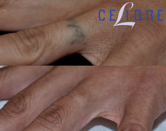 Finger Tattoo Removal  Removery