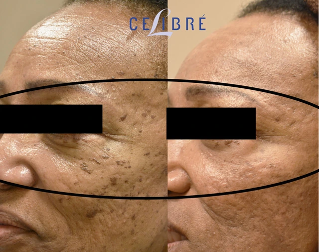 Laser resurfacing for crow’s feet before after shows smoother skin, softened wrinkles, brighter eyes, refreshed appearance, renewed confidence over time.