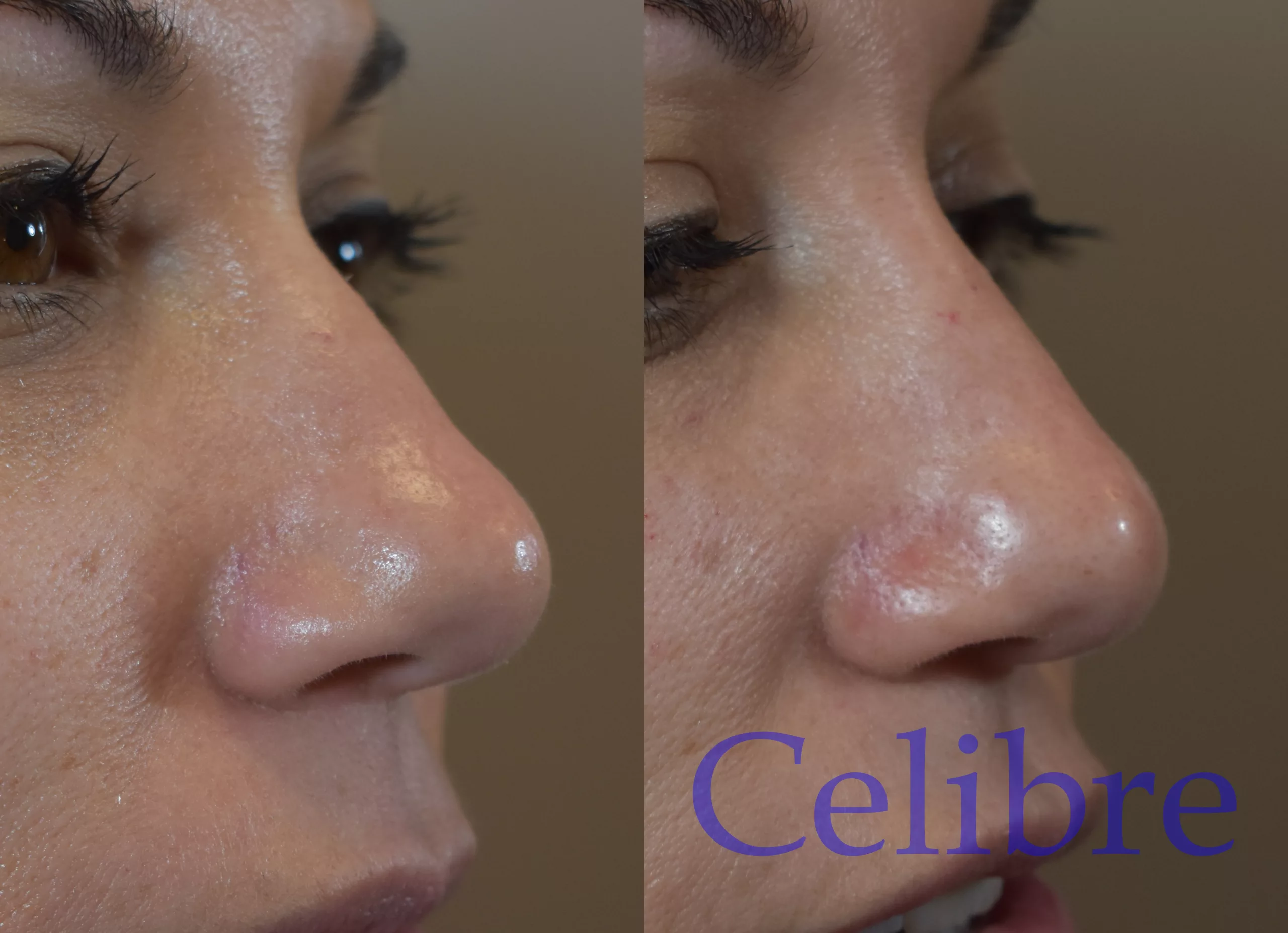 Transform Your Nose with Non-Surgical Rhinoplasty in Torrance