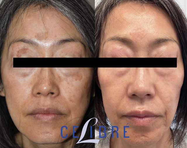 Before and after results of age spot removal with lasers on Asian skin, showing a clearer and more even complexion.