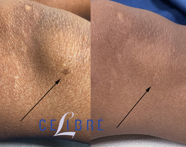 Age spot removal on Black skin before and after laser treatment