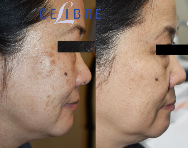 Korean skin brown spot removal before after laser, showing visible fading of pigmentation and clearer skin.