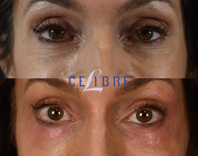 Remove fine lines under the eyes before after reveals smoother skin, reduced wrinkles, brighter eyes, refreshed appearance, youthful confidence naturally.