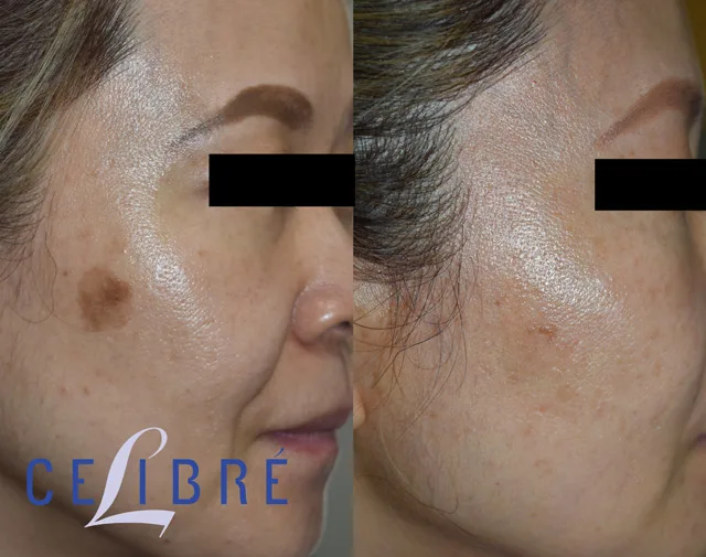 Before-and-after photos of age spot removal in Los Angeles, showcasing laser treatment results that help reduce the appearance of age spots, sun damage, and uneven skin pigmentation.