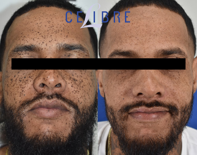 Laser treatment results: dark freckle removal on black skin with reduced pigmentation and improved clarity.