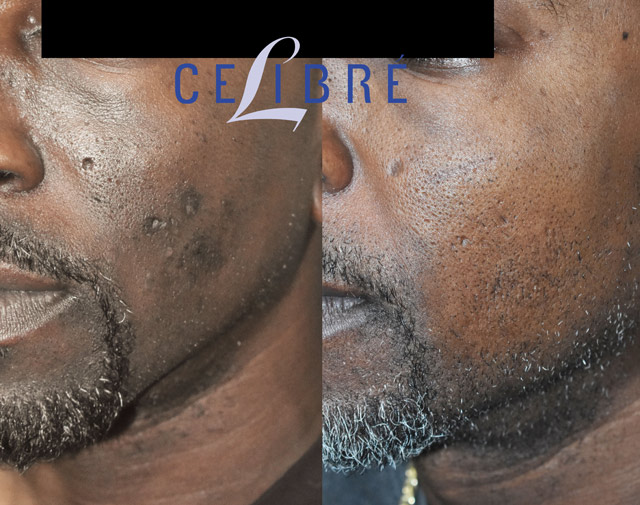 Effective laser resurfacing procedure designed to improve deep ice pick acne scars on darker skin tones with minimal irritation.