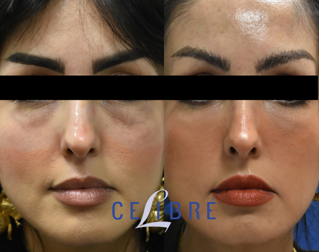 Before and after photos showing under-eye filler with Restylane results for refreshed, smoother-looking eyes in Los Angeles.