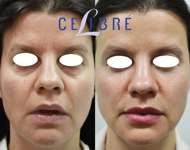 Restore a youthful look and remove dark hollows under the eyes with expertly placed dermal filler injections.