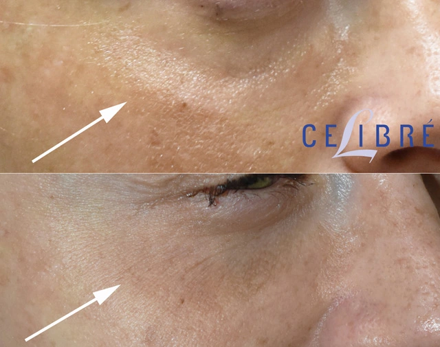 Before and after results showing improved under-eye hollowing following Restylane treatment for a smoother, refreshed appearance.