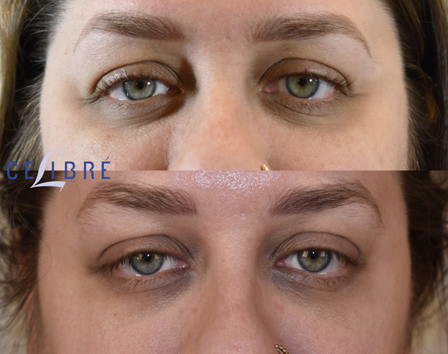 Under Eye Bags and Hollows - Allure Medical Spas