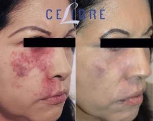 Port Wine Stain Laser Treatment