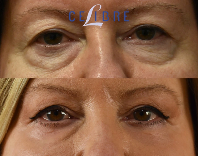 Fine lines and wrinkles under the eyes before after reveals smoother skin, reduced creases, brighter eyes, refreshed appearance, youthful confidence.