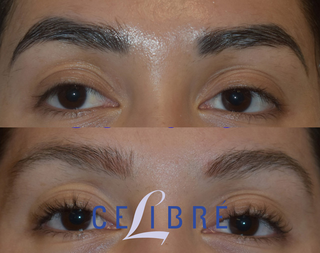 Permanent Makeup Removal Before After
