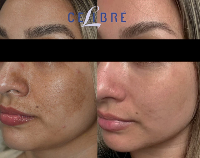Amazing results with laser removal of cafe au lait birthmark — before & after photos showcasing visible skin improvement through advanced laser treatment. Clearer, more even-looking skin starts with expert care.
