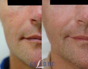 Sculptra Before and After Picture Gallery