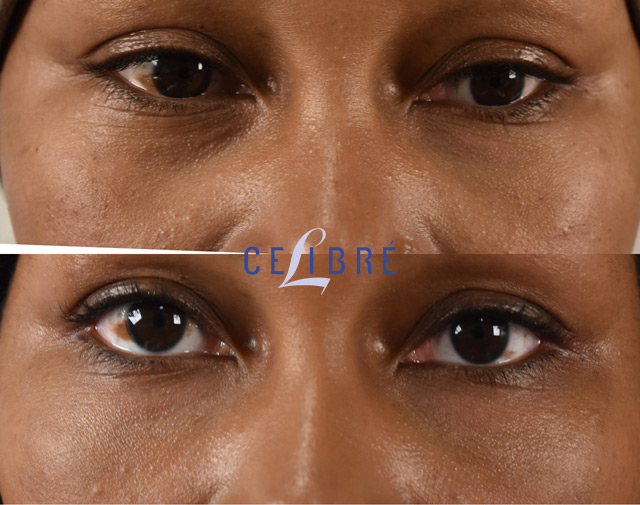 Lower Blepharoplasty Before and After Gallery | Taban MD
