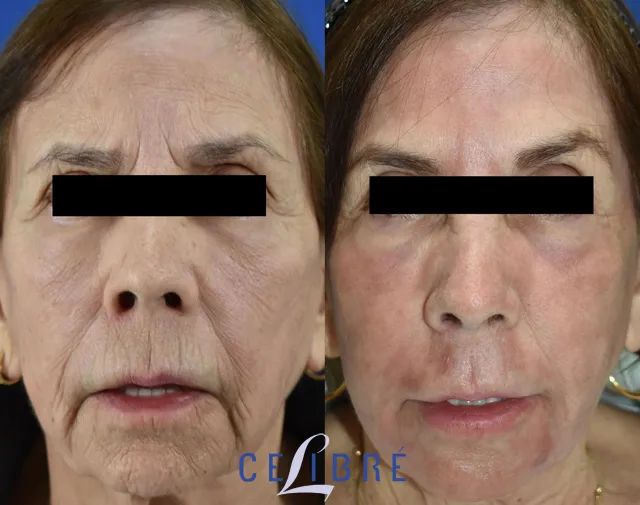 Laser resurfacing is an effective treatment for lip lines, revealing a smoother, more youthful appearance.