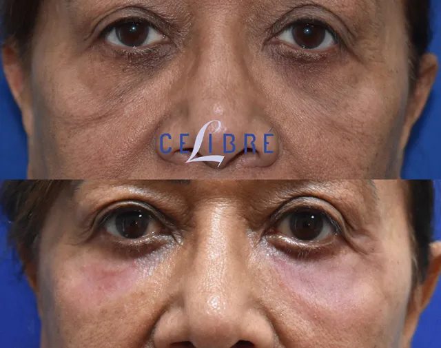 Laser resurfacing is an effective treatment to reduce wrinkles, revealing a smoother, more youthful complexion.