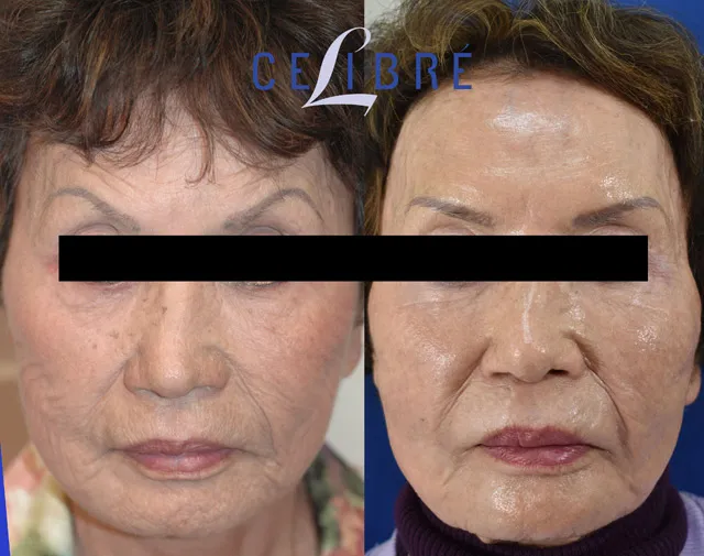 Witness the incredible before-and-after of laser resurfacing, revealing a smoother, clearer, and more youthful complexion.