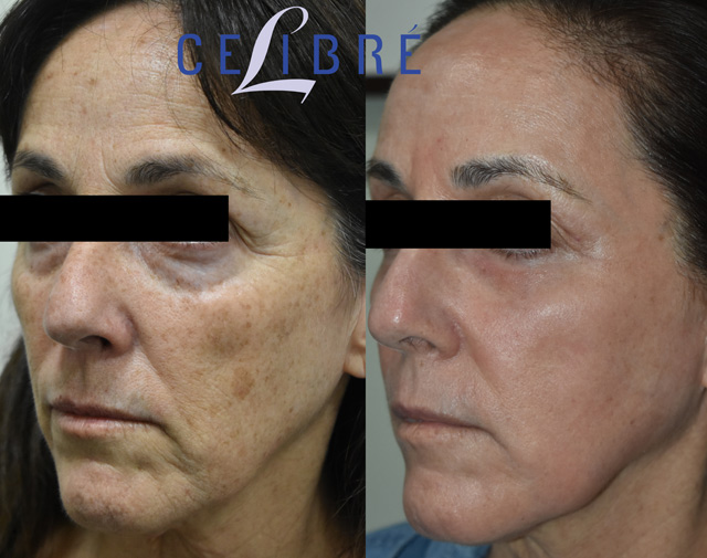 Full-field CO2 and Erbium laser resurfacing in Los Angeles rejuvenates skin, reducing wrinkles, scars, sun damage for smoother, brighter complexion.