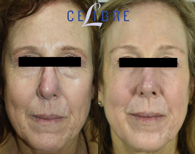 Before and after laser resurfacing results showing reduced mouth wrinkles and improved skin tone with modern skin renewal technology.