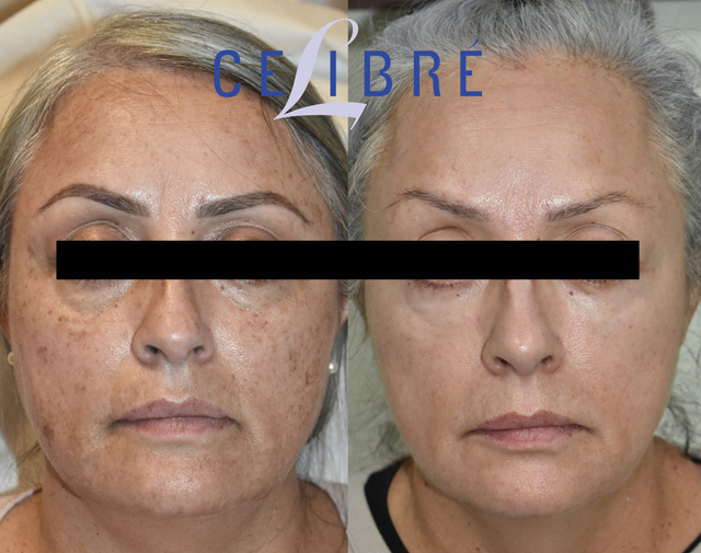 Five-year results after Erbium and CO2 laser resurfacing, showing long-lasting skin rejuvenation and smoother texture in Los Angeles.