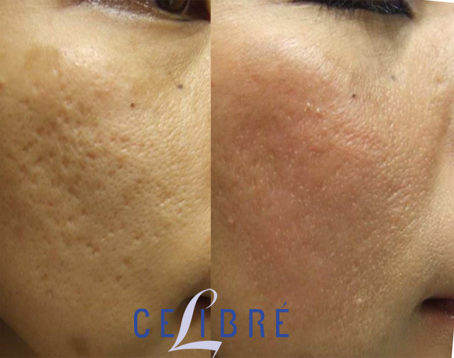 ihærdige vejkryds Underholde Acne Scar Removal Before and After Pictures of Actual Patients
