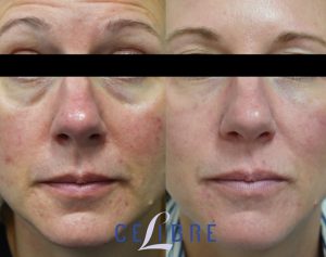 Sciton BBL (IPL) for Rosacea before and after laser treatments