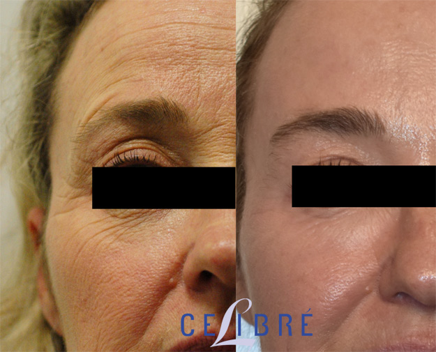 Botox Before & After Photos, Patient Photo, Pictures