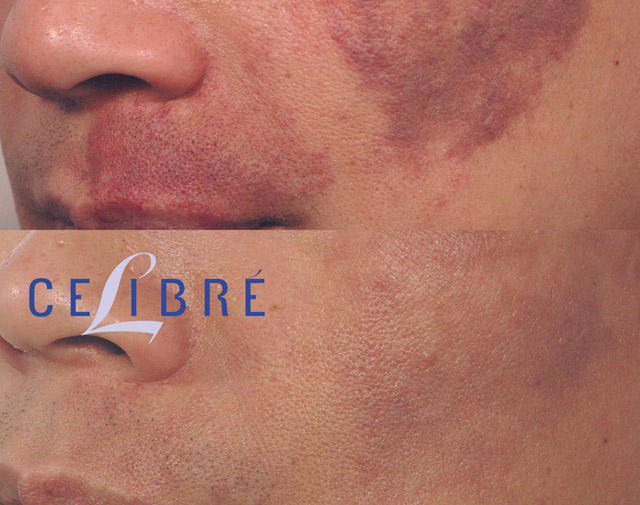 See smoother, clearer skin with facial-birthmark-removal-laser results