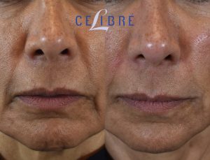 9 - facial rejuvenation with Juvederm Voluma