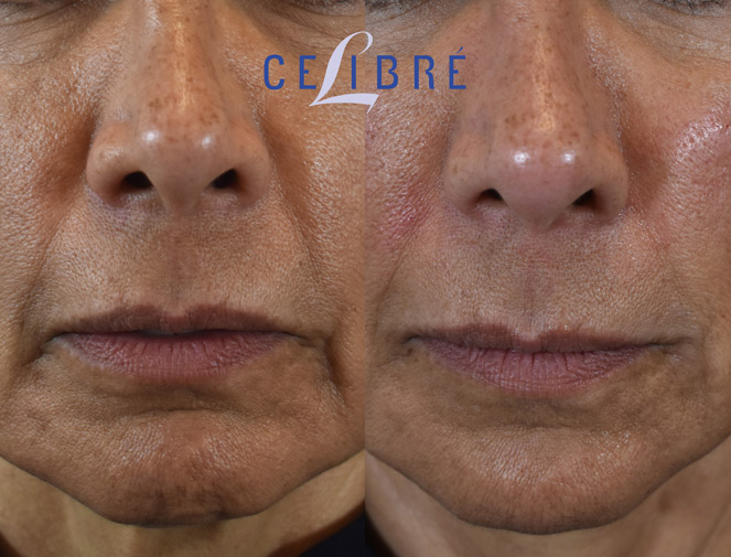9 - facial rejuvenation with Juvederm Voluma